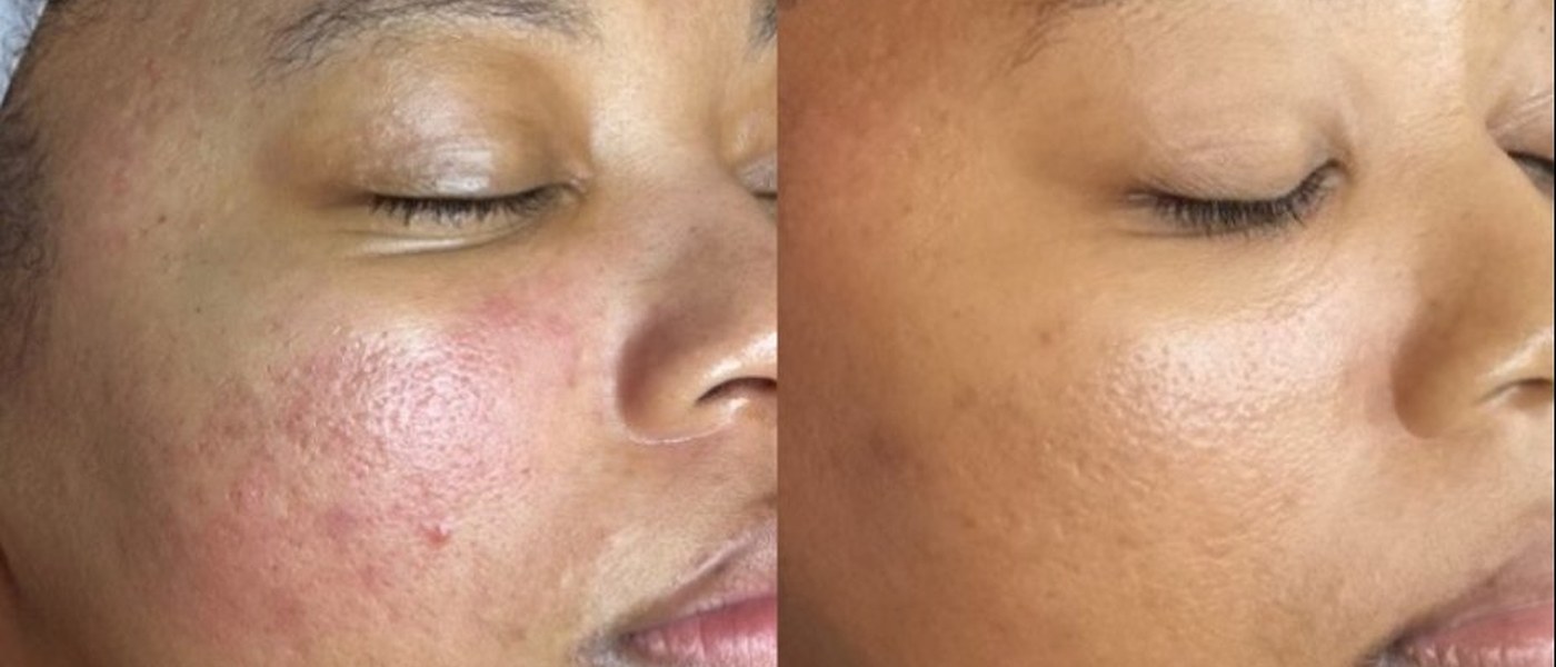 Skin rejuvenation before and after