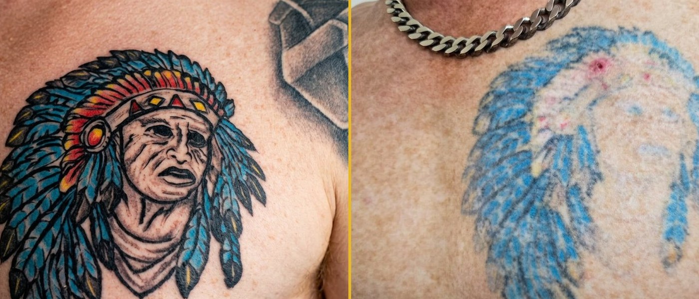 Tattoo removal before and after 4 sessions