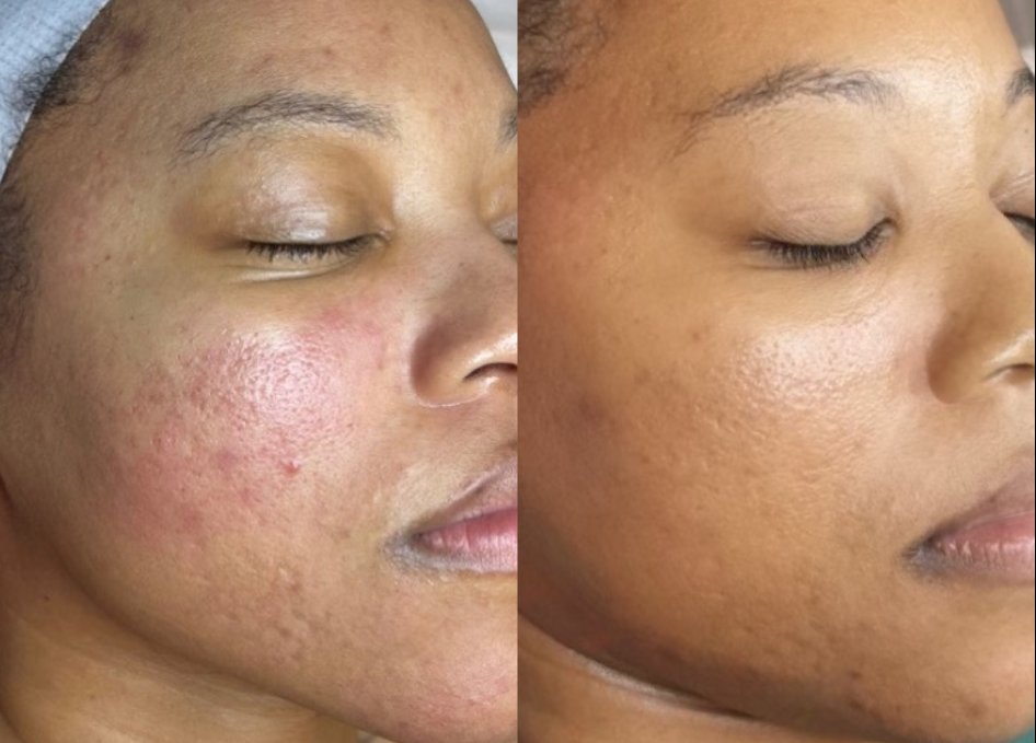 Acne therapy before and after — clearer, more even skin
