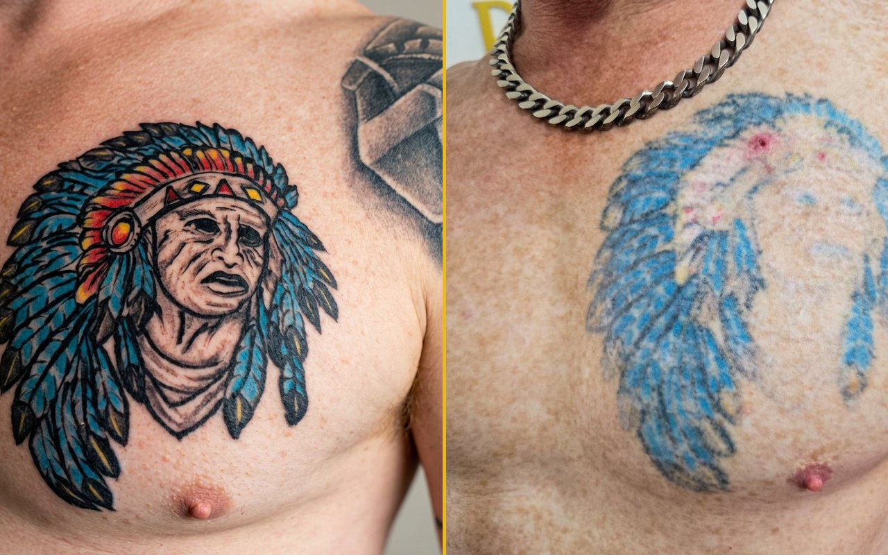 Tattoo removal before and after at RoseLuxe Beauty Laser